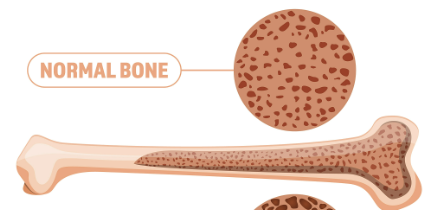 冬天最怕老人摔跤！防骨折，先预防骨质疏松！